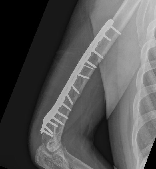 Distal posterolateral plate 2